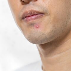 大人ニキビの原因と対処法についてご紹介！