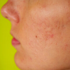 水素水でシミが消える？特徴と効果についてご紹介！