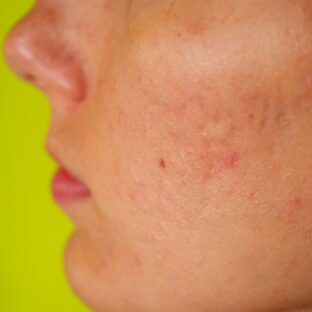 水素水でシミが消える？特徴と効果についてご紹介！